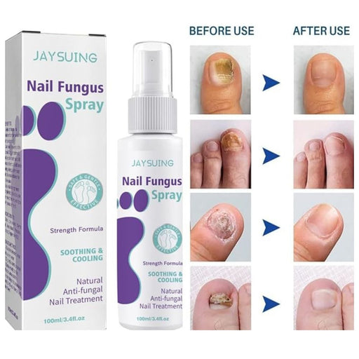 Nail Fungus Spray I  fungal nail treatment spray designed for both hands and feet I  Suitable for all skin types