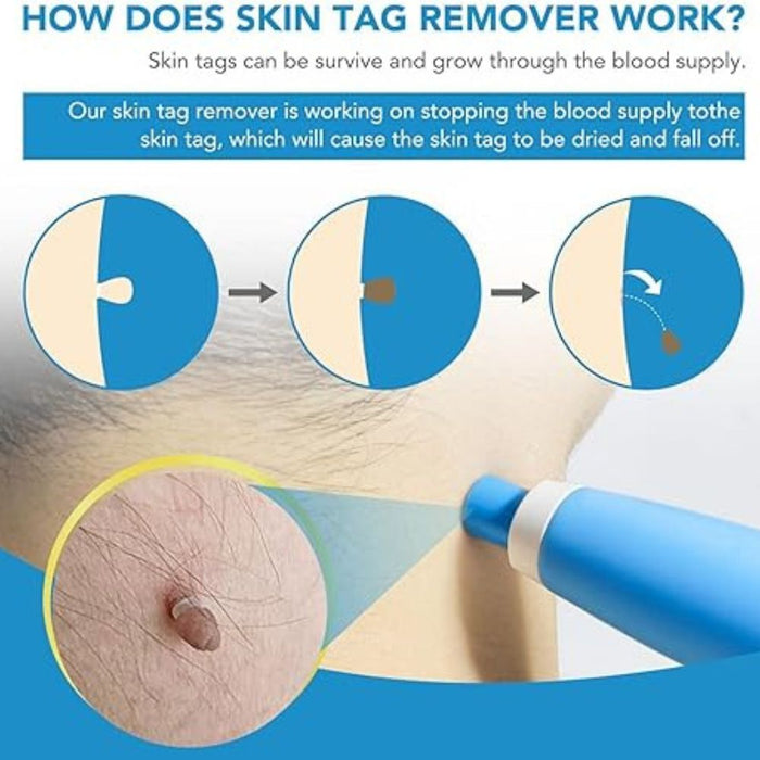 Acrochordon Skin Remover Kit I convenient to use I suitable for all skin types I remove unwanted skin tags