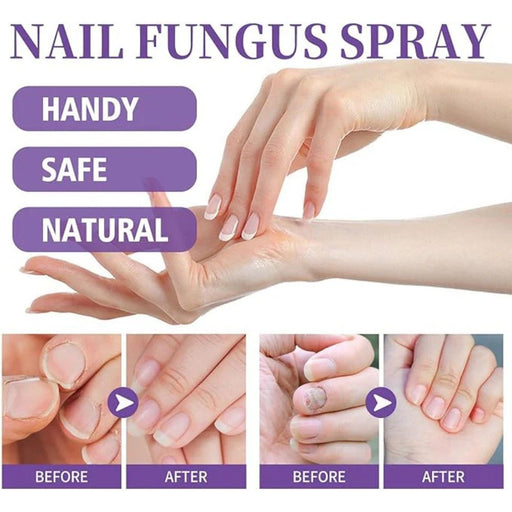 Nail Fungus Spray I  fungal nail treatment spray designed for both hands and feet I  Suitable for all skin types