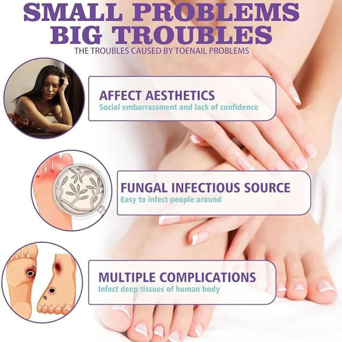 Nail Fungus Spray I  fungal nail treatment spray designed for both hands and feet I  Suitable for all skin types