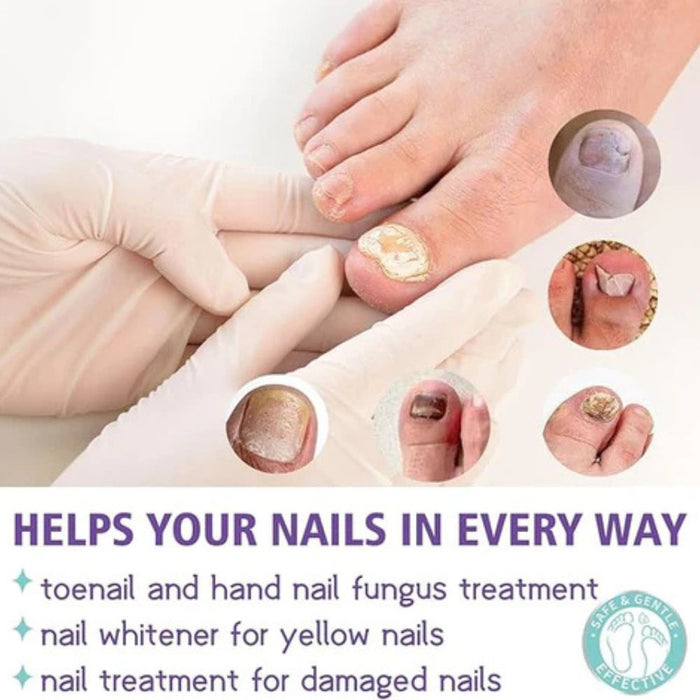 Nail Fungus Spray I  fungal nail treatment spray designed for both hands and feet I  Suitable for all skin types