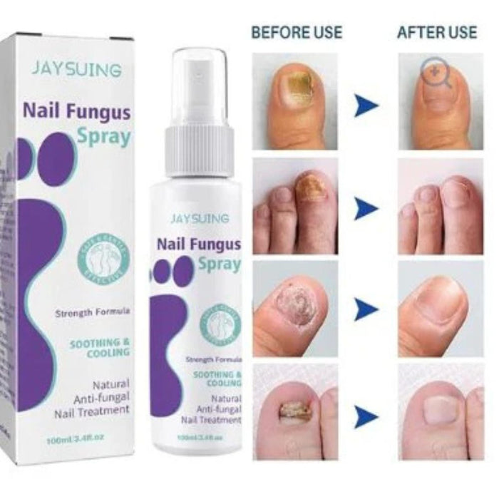 Nail Fungus Spray I  fungal nail treatment spray designed for both hands and feet I  Suitable for all skin types